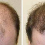 Tricopigmentazione e trapianto di capelli: soluzioni alternative o complementari?