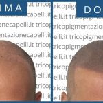 Tricopigmentazione: cos’è? Tricopigmentazione: cos’è?